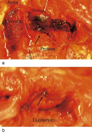 Figur 1  a) Utsnitt av aorta abdominalis, klippet opp fra baksiden, med anastomose mot protesen (graftet). Like ovenfor&hellip;