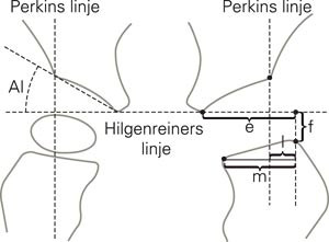 Skjematisk tegning av r&oslash;ntgen frontalbilde av bekken hos nyf&oslash;dt/spedbarn. F&oslash;rst i 3 - 4 m&aring;neders alder er kjernen i&hellip;