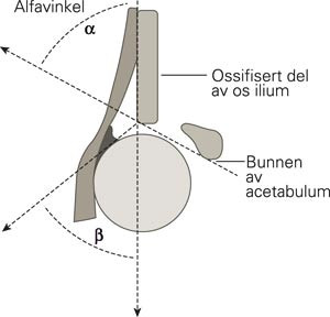 Skjematisk tegning av ultralydbildet av h&oslash;yre hofte sett forfra. Underkant av den ossifiserte del av alle tre bekkenbeina&hellip;