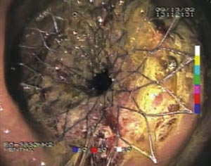 Figur 2 Stent p&aring; plass etter innleggelse