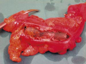 Figur 3 Operasjonspreparat spaltet med stent p&aring; plass i god posisjon