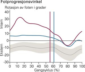 Pasient 2. Kinematiske kurver i transversalplan, som viser posisjonen til venstre fot i gangretningen. Horisontal r&oslash;d kurve&hellip;