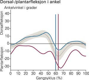 Pasient 3. Kinematiske ankelkurver av venstre fot i sagittalplanet. Horisontal r&oslash;d kurve er f&oslash;r behandling med&hellip;