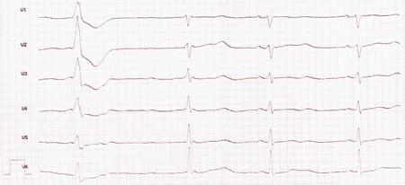 Figur 1 EKG av pasient 1 viste tydelig forlenget QT-tid. QT-tiden ble m&aring;lt til 600 ms, og korrigert QT-tid (QTc) til 571 ms