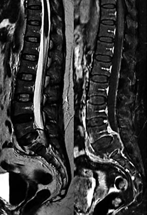 Figur 1 Pasient 2. Sagittalt MR-bilde av lumbosakralcolumna (T2- og T1-vektet med kontrast) viser abscess i virvelcorpus S1&hellip;
