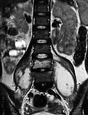 Figur 2 Pasient 3. Koronalt MR-bilde (T2-vektet) viser bilaterale psoasabscesser