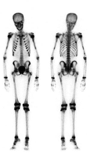 Figur 3 Pasient 4. Helkropps skjelettscintigrafi med technetium-metylendifosfonat viser disse lokaliserte aktivitets&oslash;kninger&hellip;