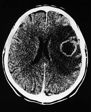 Figur 1  Cerebral CT etter intraven&oslash;s injeksjon av jodholdig kontrastmiddel viser typisk solit&aelig;r metastase med&hellip;