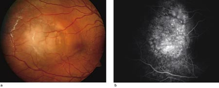 Figur 2  Pasient 3, h&oslash;yre &oslash;ye. a) Avgrenset lesjon med koroidal inflammasjon og subretinalt &oslash;dem temporalt for macula. b)&hellip;