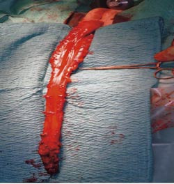 Figur 1  Bildet viser rectum og colon sigmoideum fridissekert og trukket ut gjennom anus. Saksen peker mot overgangssonen&hellip;