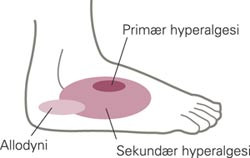 Ved vevsskade vil stimulering av nociseptorene i dette omr&aring;det gi &oslash;kt smerte (prim&aelig;r hyperalgesi). Videre vil stimulering av&hellip;
