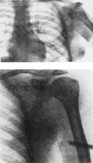 Figur 1  Forssmann med kateteret han har tr&aelig;dd i hjertet, hentet fra Forssmanns artikkel i Klinische Wochenschrift (8)