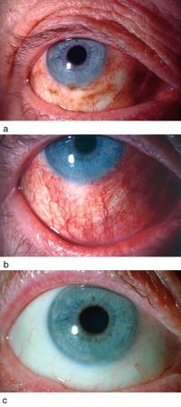 Figur 1  a) Pasient 1. H&oslash;yre &oslash;ye til en 73 &aring;r gammel kvinne, med multiple, pigmenterte flekker i conjunctiva pga. prim&aelig;r&hellip;