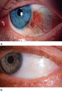 Figur 2  a) Pasient 2. Venstre &oslash;ye til en 49 &aring;r gammel mann, med pigmentering i nedre temporale del av conjunctiva pga&hellip;