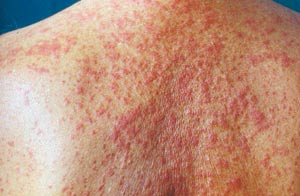 Figur 1  Eksantematisk (makulopapul&oslash;st) legemiddelutslett (etter inntak av terbinafin)