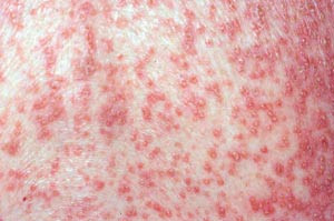 Figur 2  Pustul&oslash;st legemiddelutslett (akutt generalisert eksantematisk pustulose) (etter inntak av et betalaktamantibiotikum)