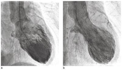 Figur 1  Venstre ventrikulografi i akuttfasen (pasient 2). Bilder i a) diastole b) og systole. Basale segmenter av venstre&hellip;