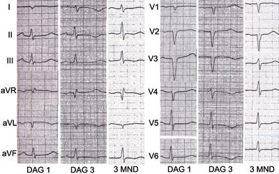 Figur 2  Elektrokardiografi (pasient 3). EKG viser sinusrytme og R-tap i avledningene I, AVL og V₁&thinsp;&ndash;&thinsp;V4 samt negative T&hellip;