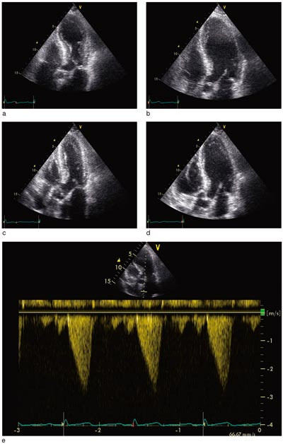 Figur 3  Ekkokardiografi (pasient 3). Firekammerprojeksjon i a) systole og b) diastole i akuttfasen og etter seks dager i c)&hellip;