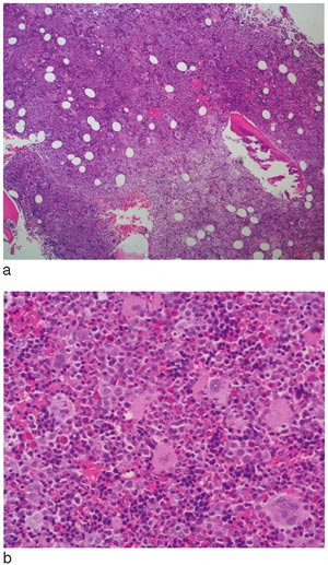Figur 1  a) Hypercellul&aelig;r beinmarg, cellularitet rundt 95&thinsp;% b) Triline&aelig;r hyperplasi med auka mengde megakaryocyttar, livleg&hellip;