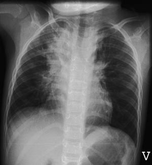 Figur 5 R&oslash;ntgen thorax av pasient 2 ved innleggelse. Uttalte bilaterale hilusn&aelig;re infiltrater med atelektatisk preg og en&hellip;