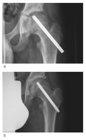 Figur 3  Reduksjon av skruens protrusjon ved den laterale cortex. a) postoperativt, b) f&oslash;r fjerning av skruen