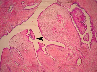 Figur 1  Fra mammatumor. Typisk fyllodem&oslash;nster. Bladliknende (phyllo = blad) innbuktninger av relativt cellefattig stroma i&hellip;