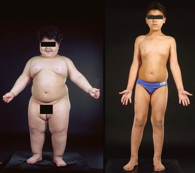 Figur 2  En pasient med kongenitt leptinmangel f&oslash;r og etter substitusjonsbehandling (13). &copy; 2003 The Endocrine Society