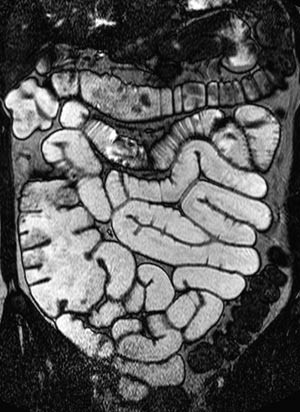 Figur 2  Sondeunders&oslash;kelse. Koronal B-FFE. Proksimale tynntarm er godt utvidet