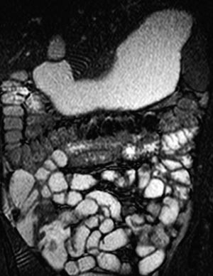 Figur 4  Koronal B-FFE. &laquo;Drikkeunders&oslash;kelse&raquo;, der pasienten har f&aring;tt ventrikkelretensjon