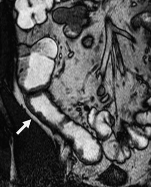 Figur 6  Koronal B-FFE. Sondeunders&oslash;kelse. 46 &aring;r gammel mann med kliniske tegn p&aring; aktiv Crohns sykdom. Det foreligger en&hellip;