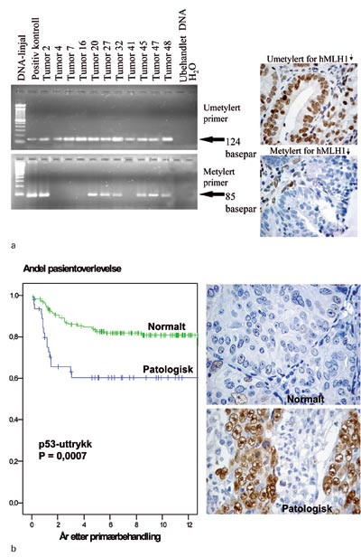 Figur 1  Eksempler p&aring; tumorbiologiske prognostiske faktorer ved endometriecancer. a) P&aring;visning av mikrosatellittinstabilitet&hellip;