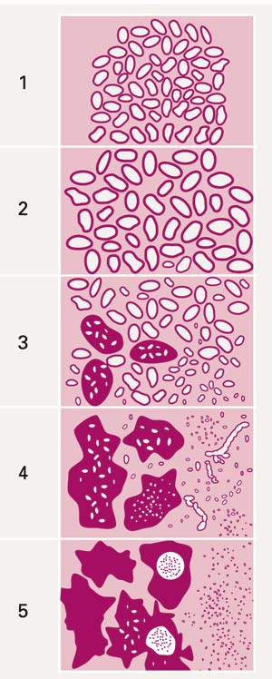 Enkelt, skjematisk diagram av Gleasons graderingssystem. Graderingen baserer seg p&aring; de ulike vekstm&oslash;nstrene vi kan se i&hellip;