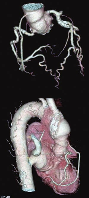Figur 2  CT-unders&oslash;kelse av kransarterier og aorta hos pasient med bypass. Fra Rikshospitalet