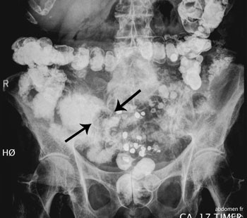 Figur 2  R&oslash;ntgen tarmpassasje viser passasje av kontrast til normal vid colon, men f&oslash;rst etter 17 timer. Litt kontrast er&hellip;