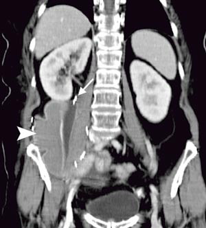 Figur 2  Tumorsengen markert med metallklyper (pil) etter reseksjon. Implantert silikonprotese (pilhode)