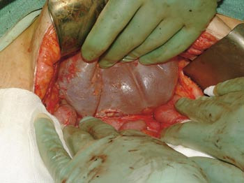 Figur 4  Protesen fjernes etter bestr&aring;ling