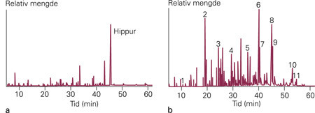 Organiske syrer i urin fra normalperson og pasient med defekt av langkjedet 3-hydroksy-acyl-CoA-dehydrogenase (LCHAD). De&hellip;