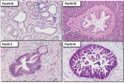 Figur 2  Histopatologiske bilder ved ulike grader av pankreatisk intraepitelial neoplasi (PanIN). For beskrivelse se tabell&hellip;