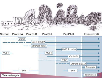 Figur 3  Progredieringsmodell for utvikling av duktalt adenokarsinom i pancreas via PanIN-forstadier. Pilene antyder ved&hellip;