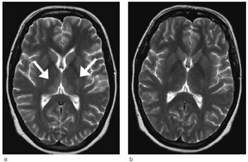 Figur 2  T2-vektede bilder i samme niv&aring; som i figur 1a. a) 19 dager etter innleggelse. Tydelig tilbakegang siden f&oslash;rste&hellip;