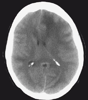 Figur 2  CT like f&oslash;r dekomprimerende kraniektomi