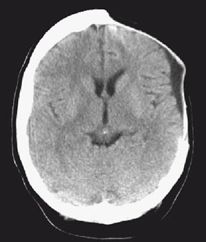 Figur 3  CT fem uker postoperativt