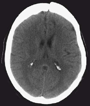 Figur 4  CT fem m&aring;neder postoperativt