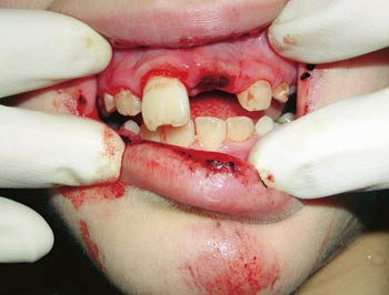 Figur 2  Tom alveol etter eksartikulasjon av incisiv i overkjeve. Emaljefraktur p&aring; nabotannen