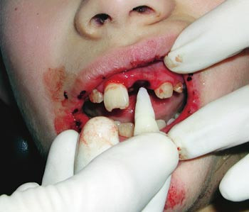 Figur 3  Tannen replanteres med fingertrykk i alveolen uten &aring; ber&oslash;re rotoverflaten. Noter emaljefraktur p&aring; nabotannen