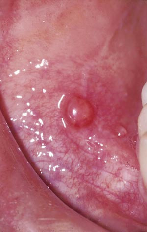 Figur 2  Bull&oslash;st pemfigoid med intakt blemme oralt. Foto Bjarte Grung