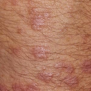 Figur 3  Lichen planus i hud. Foto Bjarte Grung