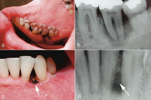 Figur 2  Klinisk (a) og r&oslash;ntgenologisk (b) horisontalt festetap uten danning av dyp beinlomme lingvalt p&aring; tann 37 hos en HIV&hellip;