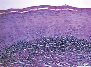 Figur 2  Biopsi av en lichenoid reaksjon i munnslimhinnen i topografisk relasjon til en amalgamfylling. Bemerk keratose p&aring;&hellip;